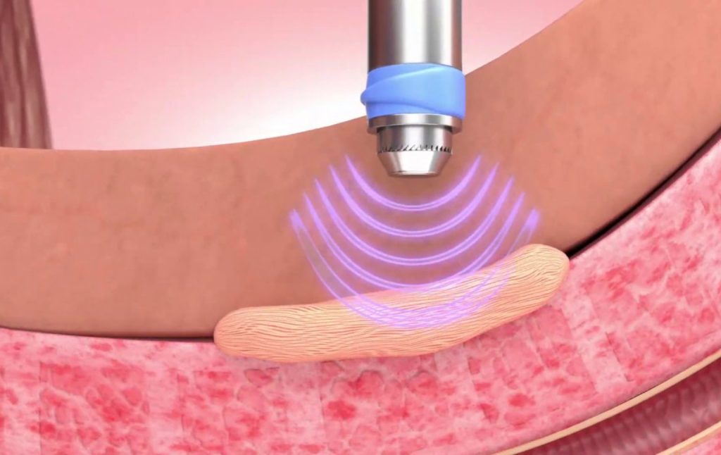 Exploring GAINSWave Therapy: A Solution for Men’s Sexual Health