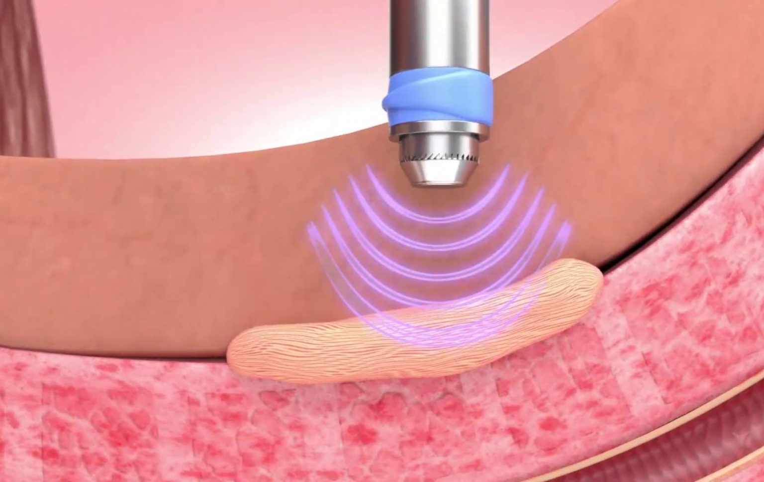 Exploring GAINSWave Therapy: A Solution for Men's Sexual Health